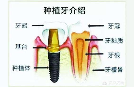 医院种植牙多少钱一颗2022价格表-种植牙一颗大概多少钱